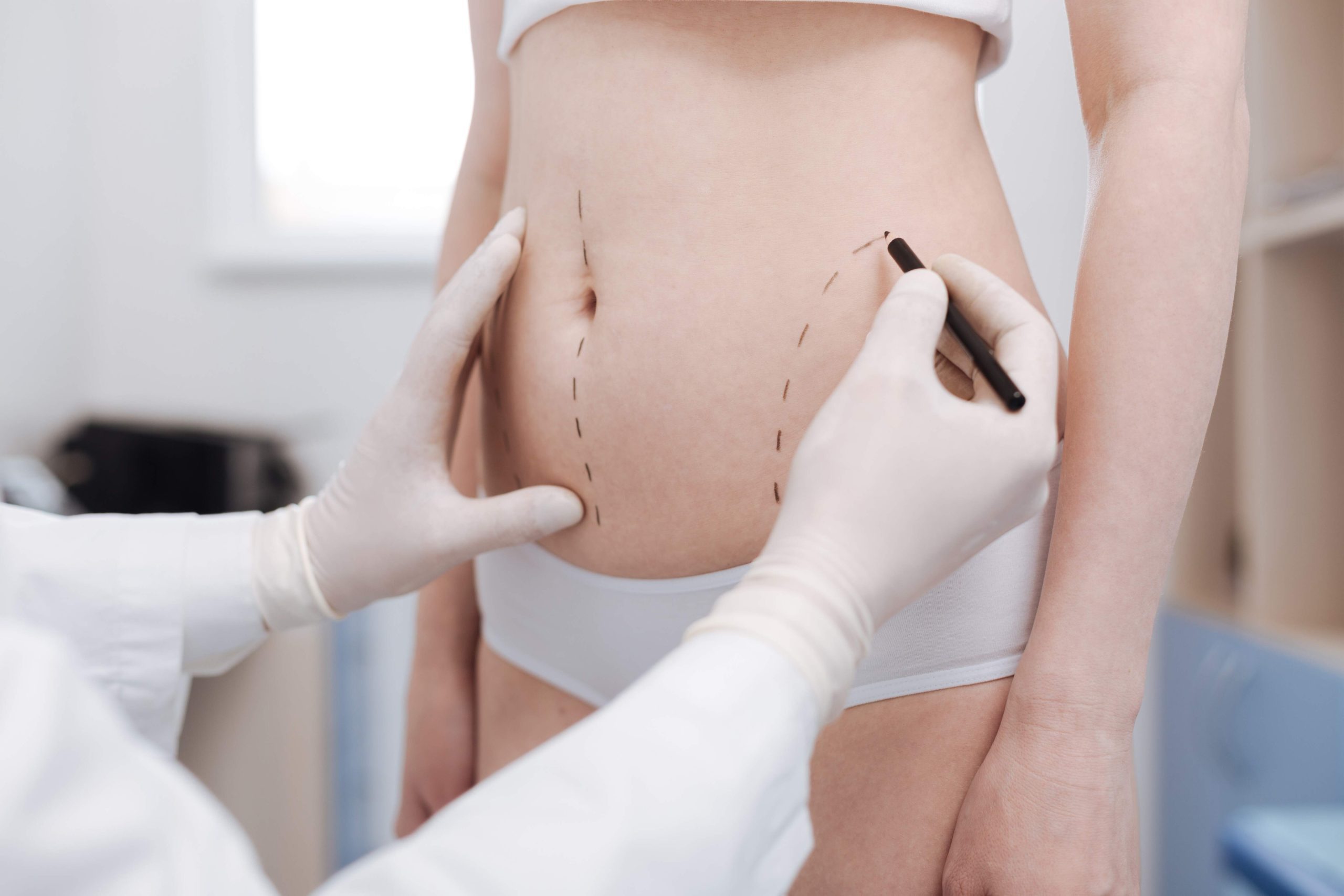 Understanding the Liposuction Procedure